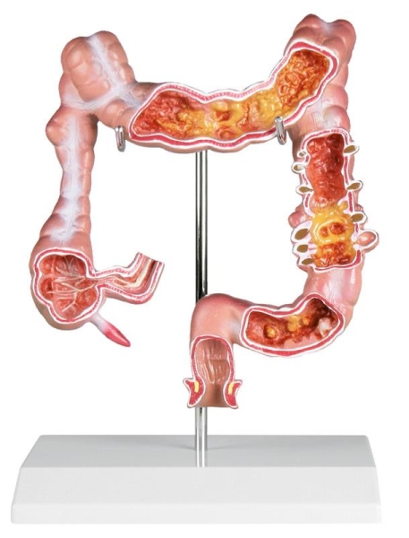(K285) Colon Model with Diseases