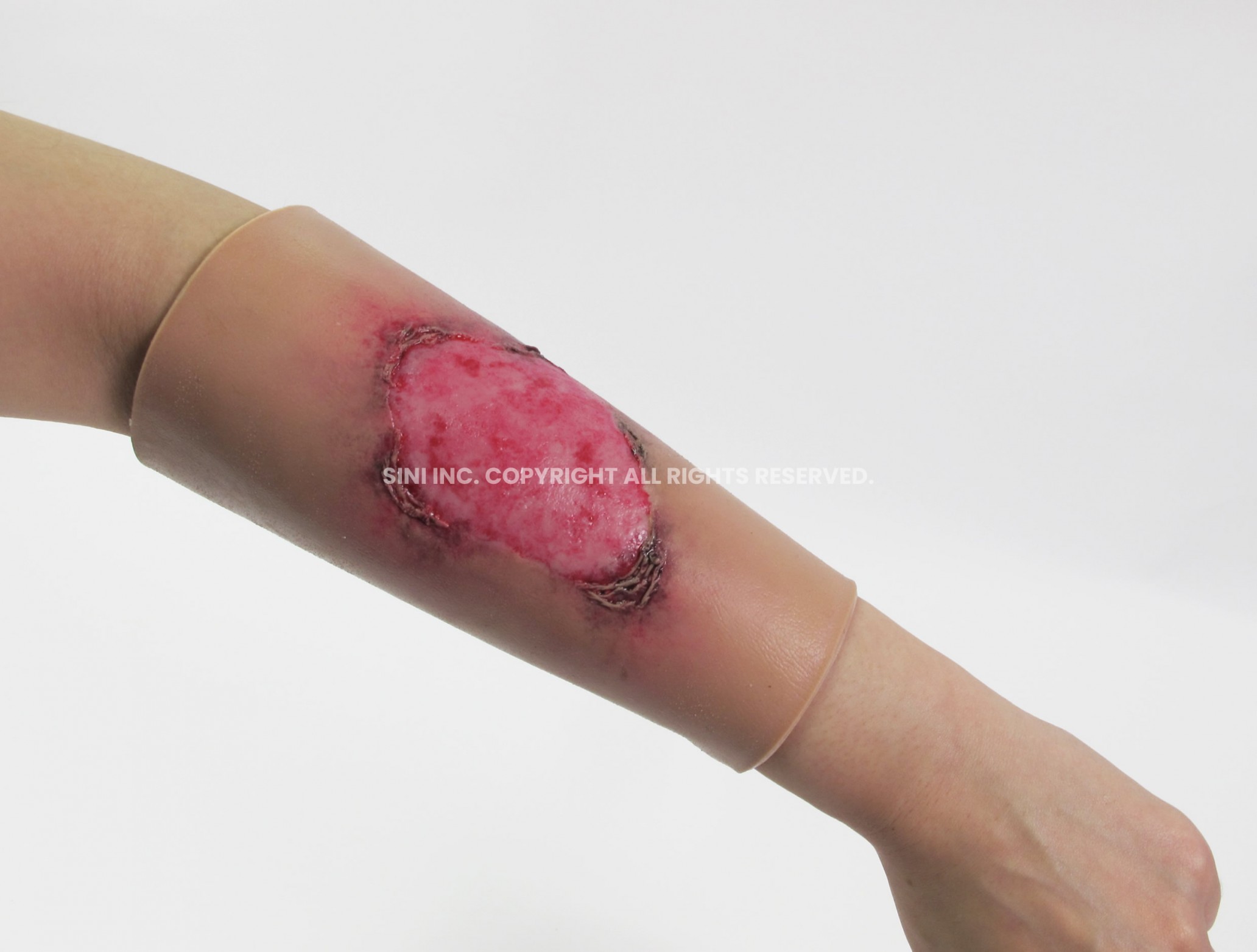 (L-BUR-01) Burn Treatment Model