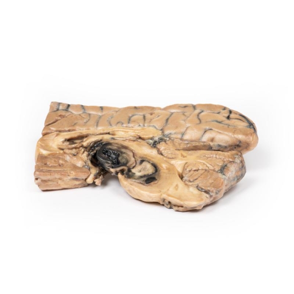 (MP2001) Berry Aneurism of Basilar Artery