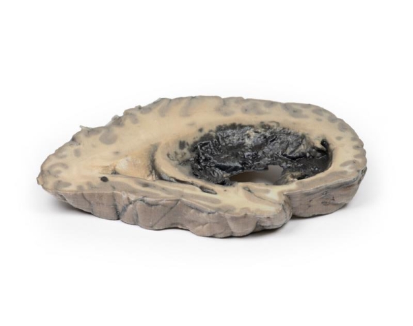 (MP2002) Cerebral Haemorrhage