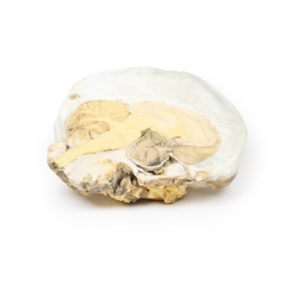 (MP2006) Pituitary Adenoma