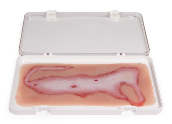 (NW108) Wound Moulage Scalding (big)